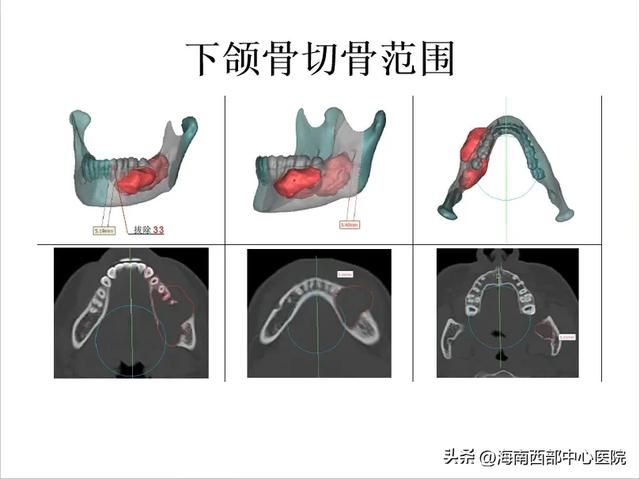 又一海南省首例！——海南西部中心医院口腔科顺利开展下颌骨肿瘤切除及腓骨皮瓣移植手术