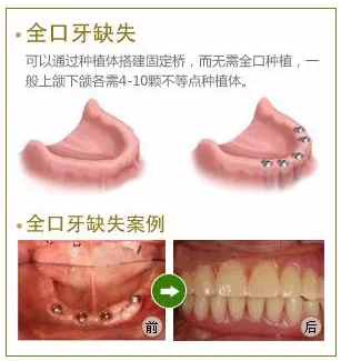 全口缺失牙，全口即刻修复种植牙技术