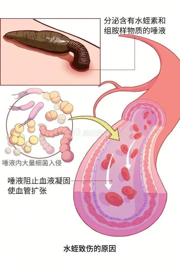 头皮发麻！3岁娃鼻子里竟有条蠕动的蚂蟥，足足4厘米长