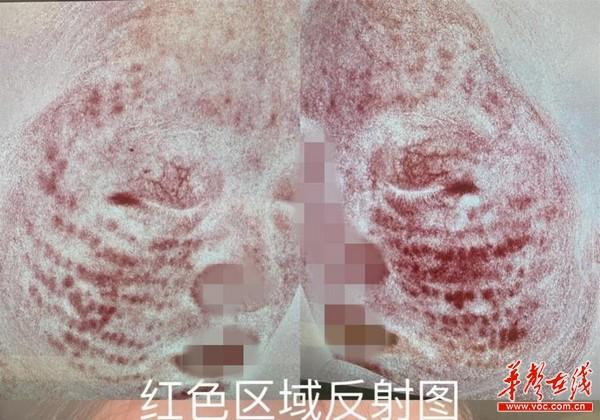 女子注射水光针后脸上留100余处“肉芽肿”美肤不成变毁肤