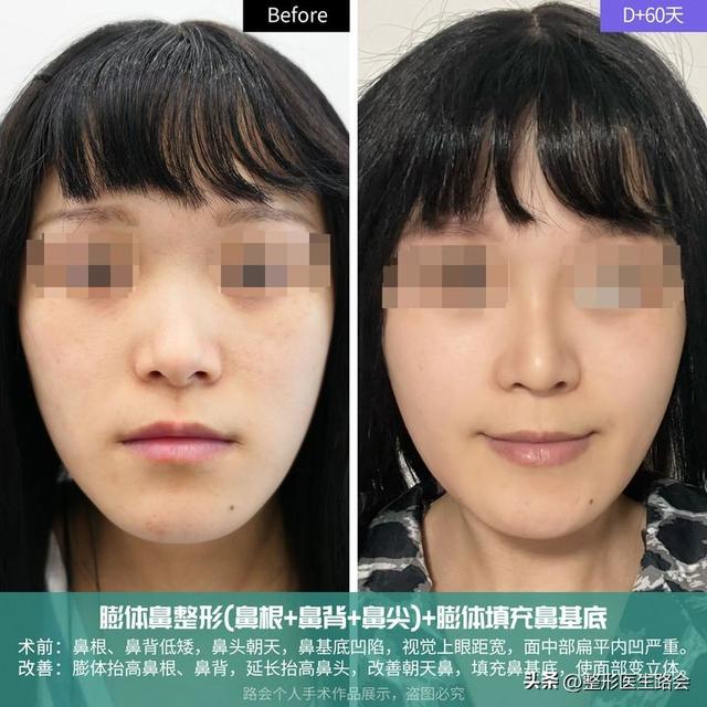 翘下巴+月亮脸，25岁女孩整容后激动地说：我终于不丑了！