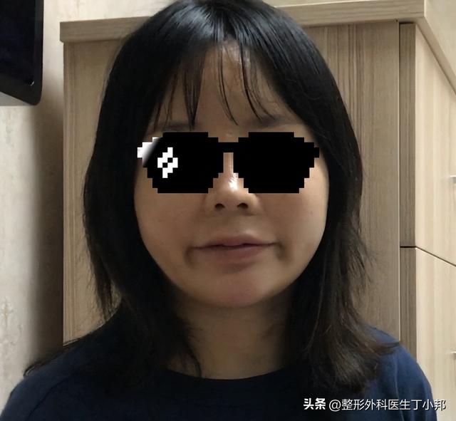 27岁美女小姐姐，打了生长因子变丑很自卑取出注射物后恢复自然