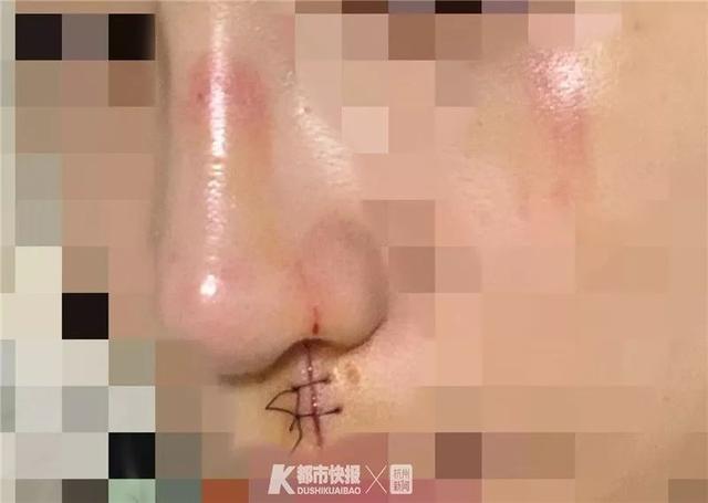 23岁美女模特玩密室逃脱被“鬼”吓到绊倒，脸部划伤缝针，她说：模特靠脸吃饭，损失很大…