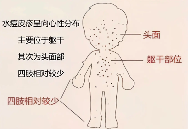 这病号称“见面传”，6岁以下的娃最容易中招！打这个疫苗能预防