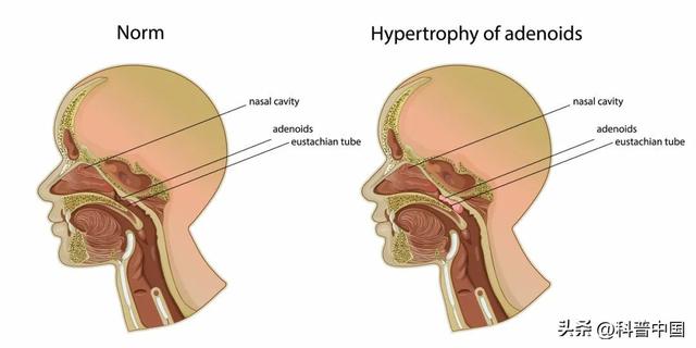 “口呼吸”刷爆热搜！不仅影响颜值还会影响发育？发现立即这样做