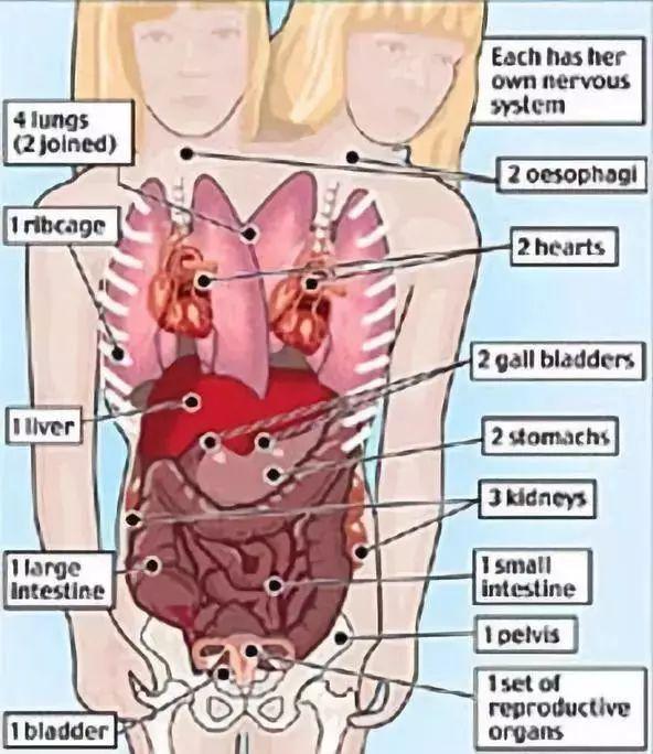 罕见双头女人，两个脑袋如何控制同一个畸形身体？