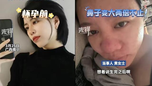 怀孕真能毁容？美女鼻子变大2倍前后对比，网友热议爱美的代价！