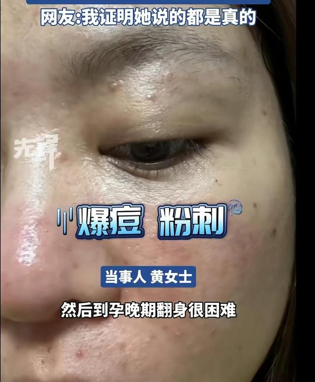 怀孕真能毁容？美女鼻子变大2倍前后对比，网友热议爱美的代价！